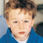 Molluscum contagiosum u detí