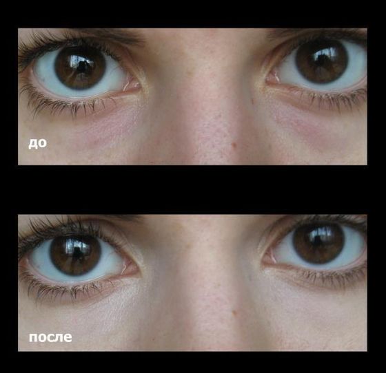 Trvalý make-up na ukrytie modrín pod očami