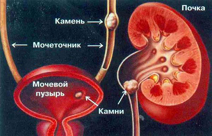 Obličkové kamene: liečba ľudovými prostriedkami