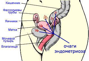 Endometrióza: liečba ľudovými prostriedkami