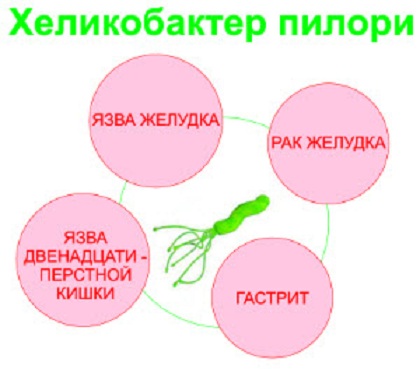 Liečba žalúdočných vredov s ľudovými prostriedkami
