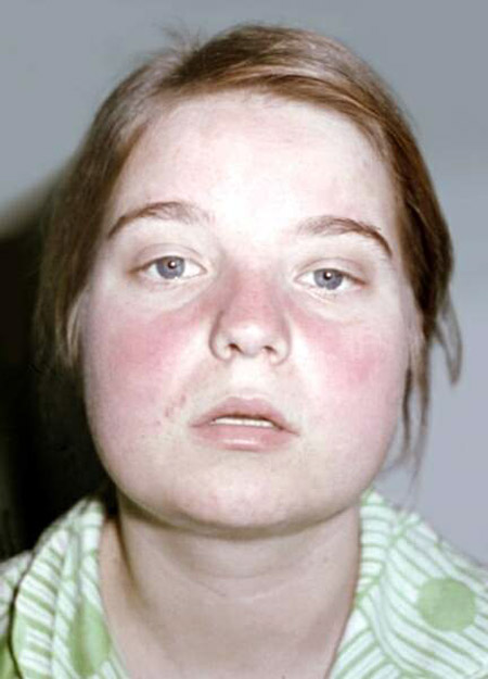 Čo je lupus? Príznaky a príčiny choroby