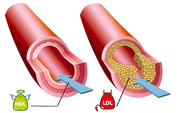 Cholesterol: mýty, pravda a odporúčania odborníkov na výživu