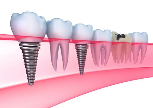 Je zubná implantácia luxusom alebo nevyhnutnosťou? 