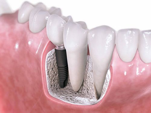Je zubná implantácia luxusom alebo nevyhnutnosťou? 