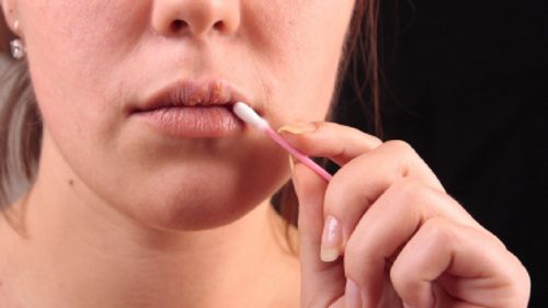 Efektívne spôsoby liečenia prechladnutia na perách