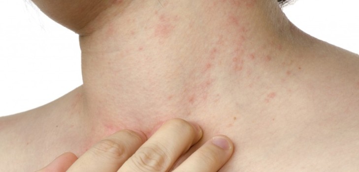 Čo spôsobuje vyrážku na krku: hlavné príčiny a spôsoby liečby
