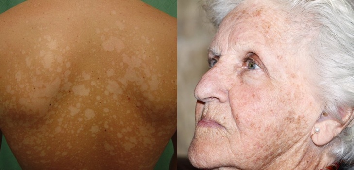 Na koži peeling
